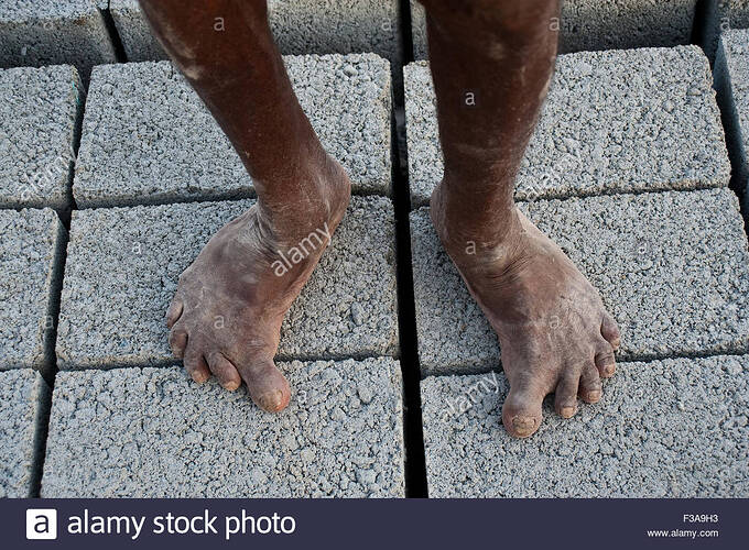 hombre-con-pies-deformes-que-trabajan-en-una-fabrica-de-ladrillos-el-esta-de-pie-sobre-bloques-de-cemento-india-f3a9h3