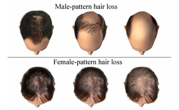 male-pattern-hair-loss-1024x630-1654907819